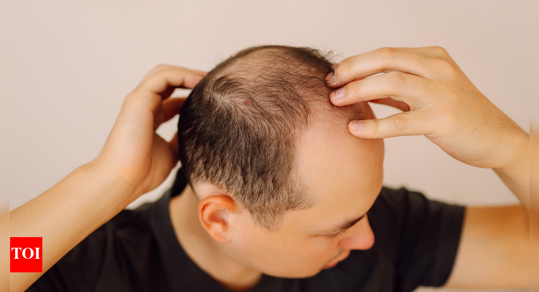 Balding (hair loss) is inherited from father’s or mother’s side? This is what Science says |