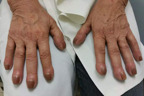 Lung cancer symptoms on fingers: Finger clubbing, nail changes and other warning signs that could indicate serious health risks