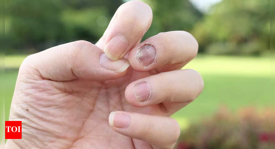6 warning signs in the nails one should not ignore: They could be indicating serious health issues |
