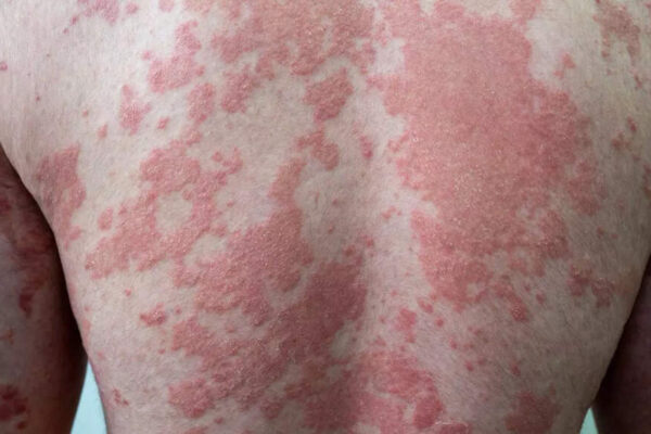 Obesity can damage your skin: Why dark patches, infections, and psoriasis are warning signs |
