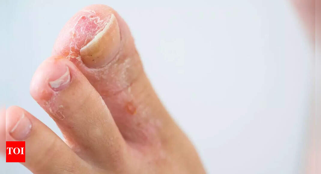 How to get rid of athlete’s foot naturally: 10 simple home remedies