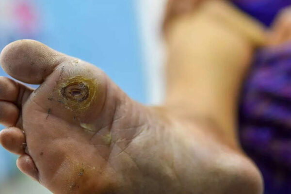 High blood sugar slowly damages your feet: Causes, symptoms and science behind diabetic foot ulcers |