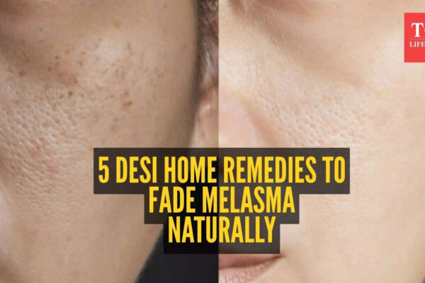5 home remedies to get rid of Melasma (Jhai)