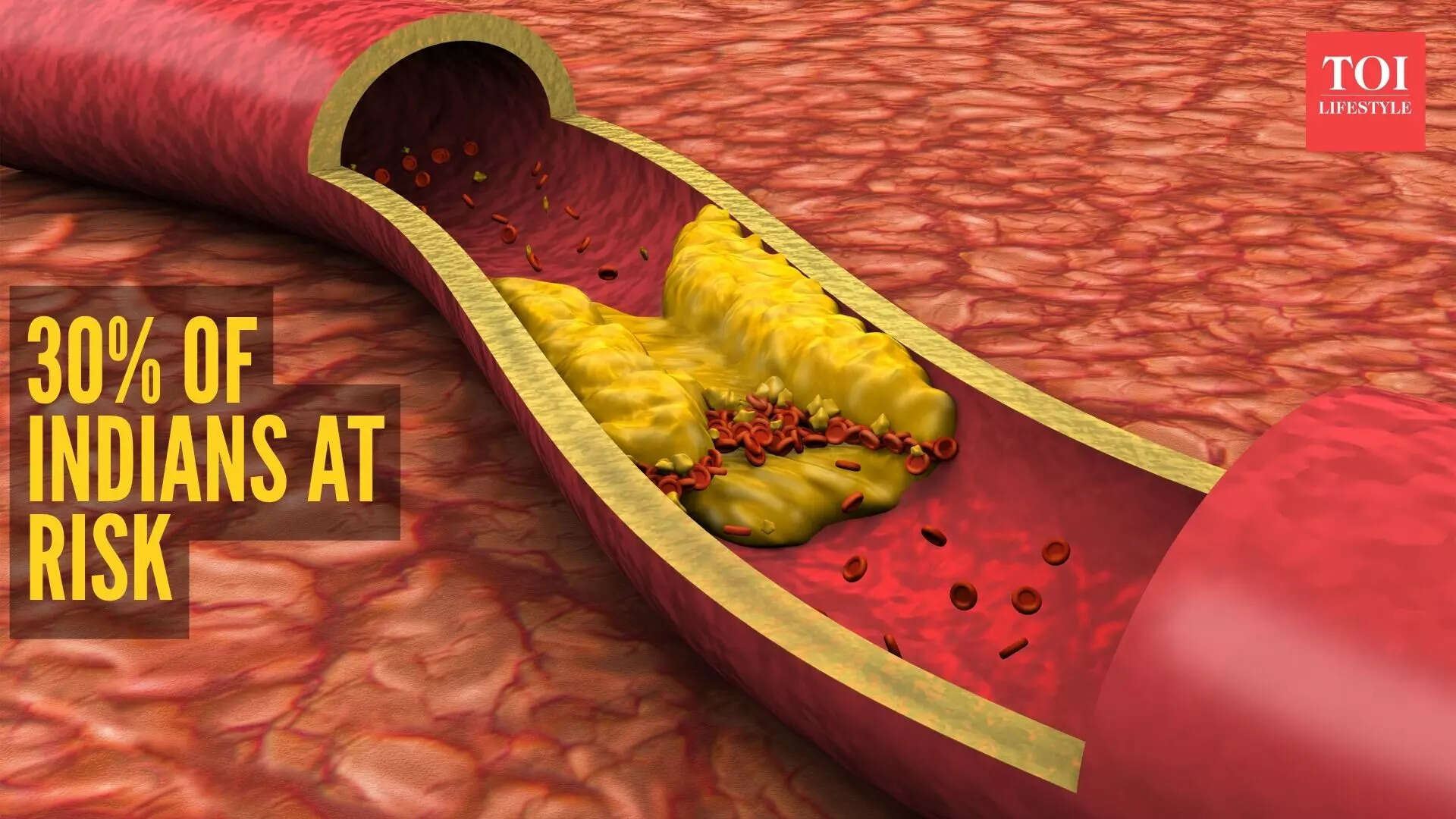 5 silent signs of high cholesterol one might miss