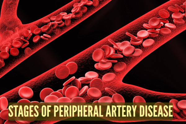 From mild circulation issues to critical limb ischemia