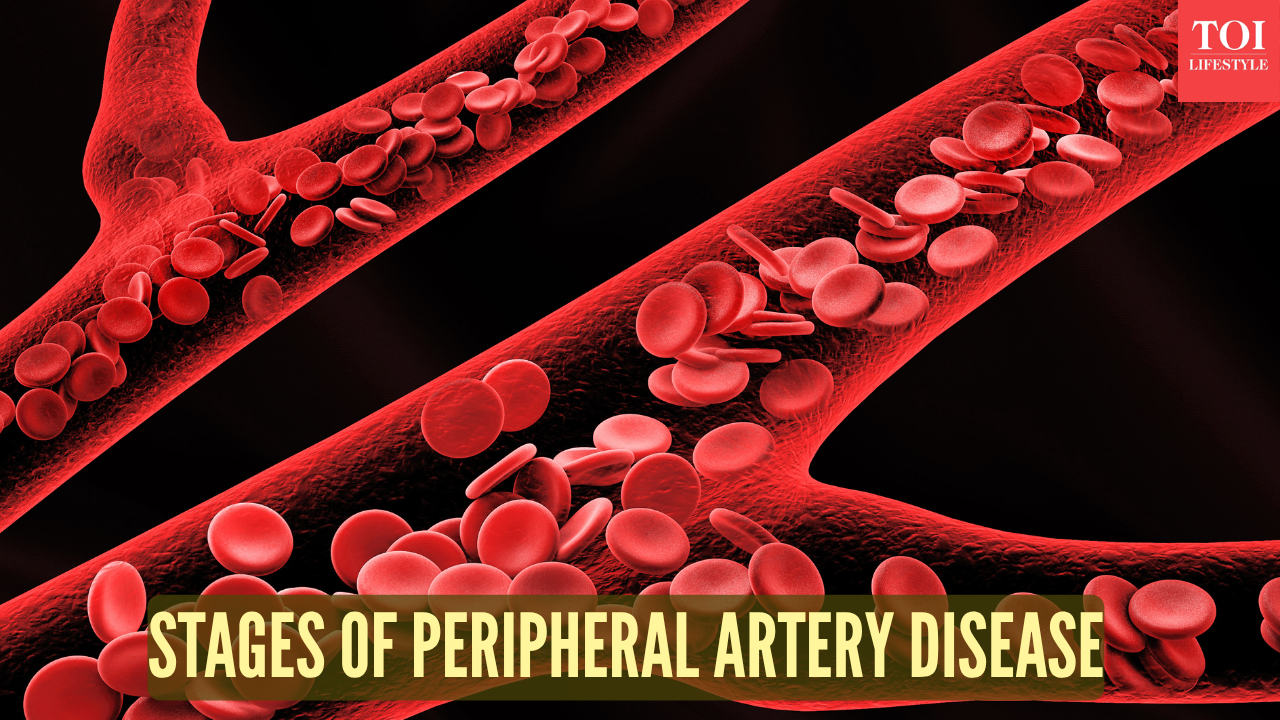 From mild circulation issues to critical limb ischemia