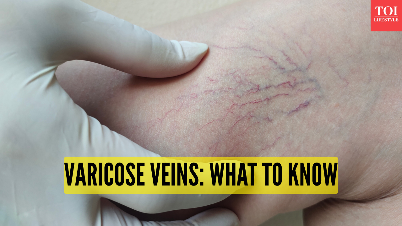 5 early varicose vein symptoms one should not ignore
