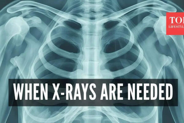 Top neurologist warns, ‘stop routine chest X-rays’: Here’s when they’re actually needed |