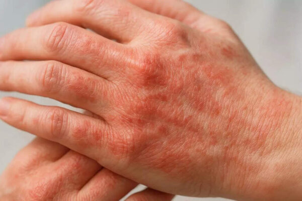 What your skin says about your health: Early signs of diabetes, liver issues, and autoimmune diseases |