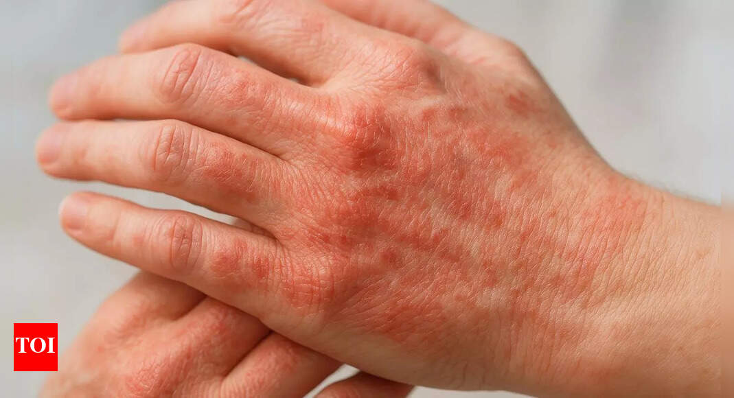 What your skin says about your health: Early signs of diabetes, liver issues, and autoimmune diseases |