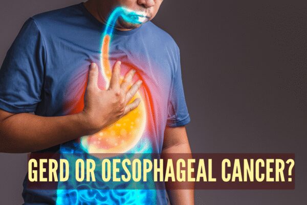Esophageal cancer vs GERD: Symptoms, causes, and key differences |