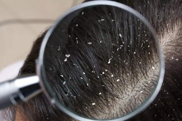 How zinc helps control dandruff and maintain a healthy, flake-free scalp |