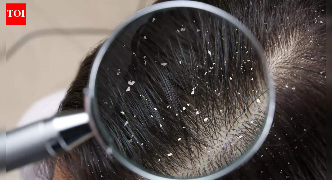 How zinc helps control dandruff and maintain a healthy, flake-free scalp |