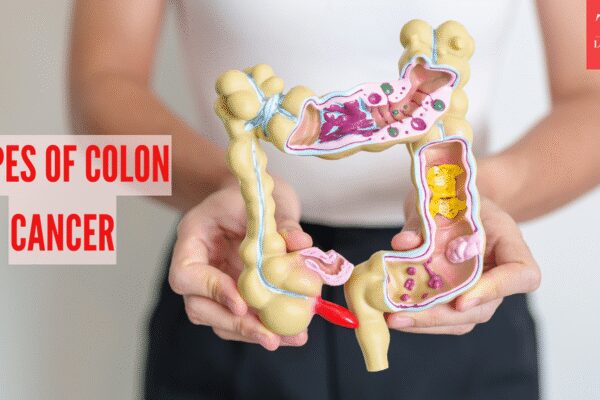 Colon Cancer Symptoms: 4 types of Colon Cancer: Symptoms, causes, and treatment