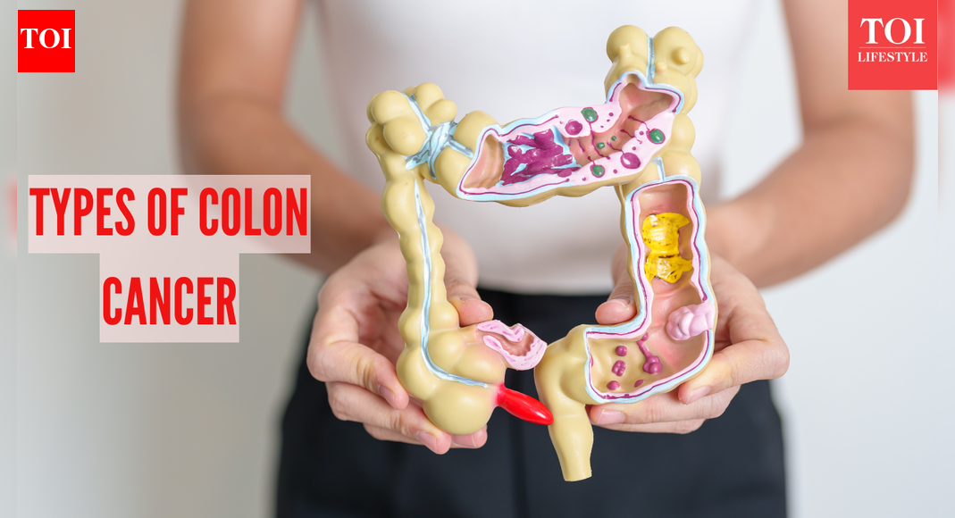 Colon Cancer Symptoms: 4 types of Colon Cancer: Symptoms, causes, and treatment