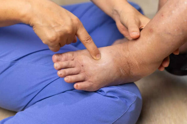 Why your ankles swell: Experts reveal 10 hidden causes, including early signs of heart failure |