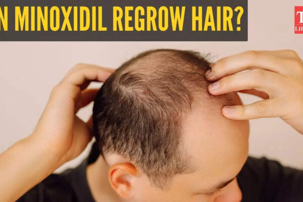Hair Growth: Can minoxidil help with hair growth? Online claims send the treatment trending |