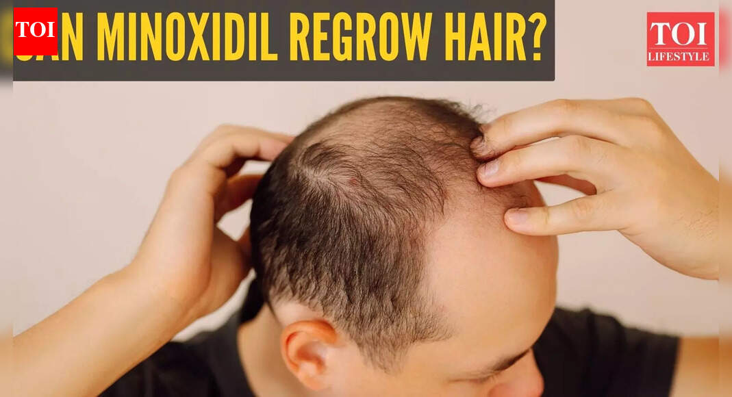 Hair Growth: Can minoxidil help with hair growth? Online claims send the treatment trending |