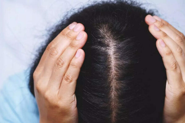 7 Home remedies for dry scalp in winter: Natural solutions to hydrate, soothe, and reduce flakes |