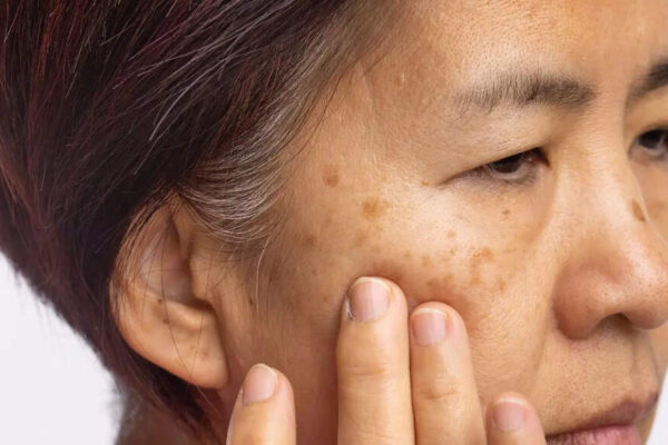 How Vitamin B12 deficiency shows up on your skin: Pigmentation, dryness, inflammation, and other warning signs |