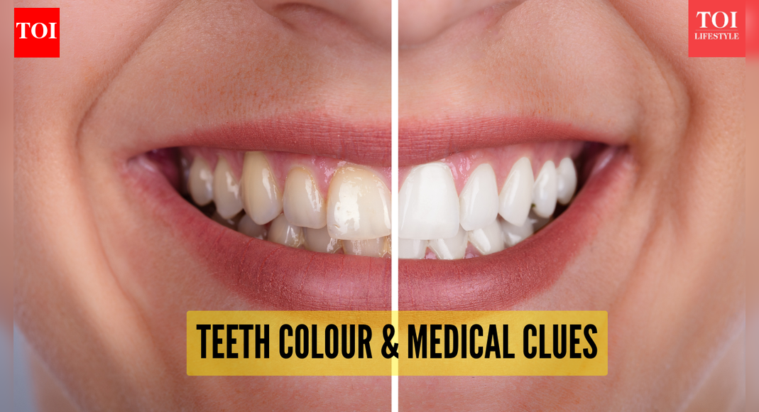 Yellow to spotted: What different types of tooth colour reveal about health, hidden medical conditions
