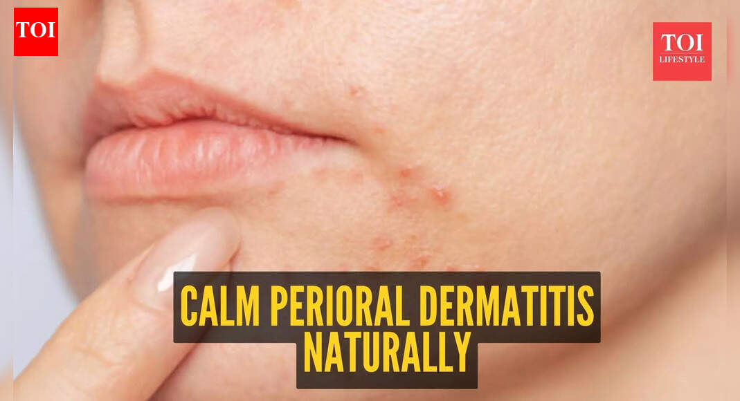 5 natural home remedies to deal with Perioral Dermatitis