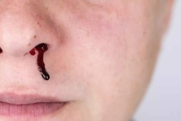 Why your nose bleeds when you sneeze and how to stop it: Common causes, risks and treatment |
