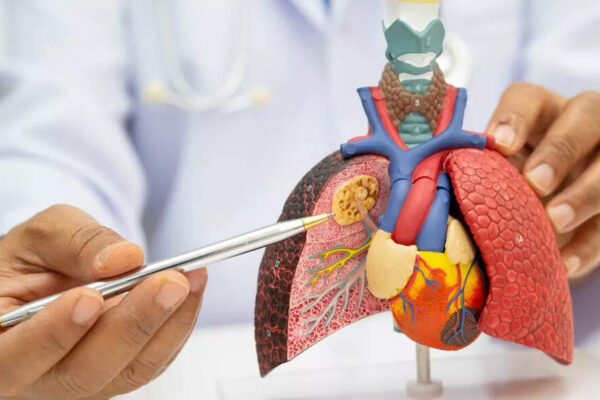 World’s first lung cancer prevention vaccine trial funded with £2.06 million to stop cancer before it starts |