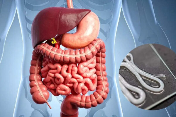Spotting worms in your poop: How to identify the types, causes, and symptoms |