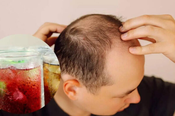 Your favourite soda could be silently causing hair loss and thinning: How sugar harms hair follicles |