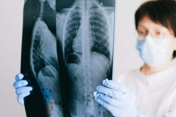 8 subtle signs of lung disease you need to recognise that go beyond cough |