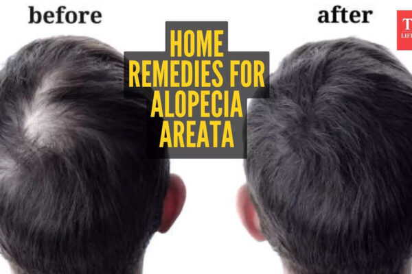Alopecia Areata home remedies: 5 natural ways of reversing it