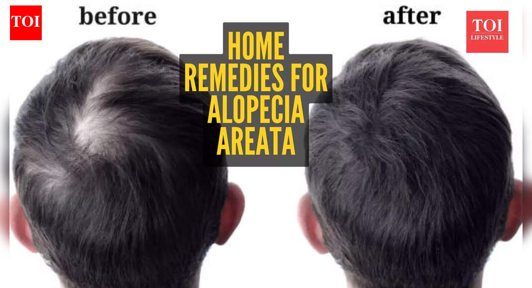 Alopecia Areata home remedies: 5 natural ways of reversing it