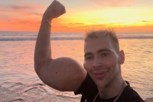 ‘Russian Popeye’: Man who injected Vaseline oil for giant biceps now faces possible arm amputation |