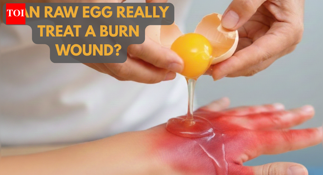 Does egg white really heal burn wounds? Doctors warn of deadly infection risk |