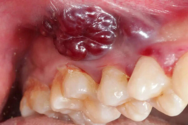 Indian women and growing oral cancer cases: Why a non-healing mouth ulcer could be the earliest red flag |