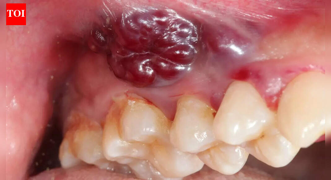 Indian women and growing oral cancer cases: Why a non-healing mouth ulcer could be the earliest red flag |