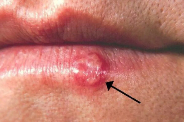 Herpes simplex virus: Understanding its symptoms, outbreak causes, how it spreads and tips for managing the infection |