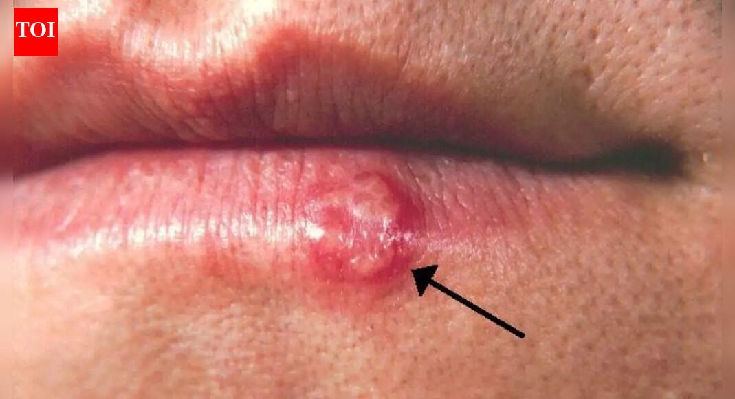 Herpes simplex virus: Understanding its symptoms, outbreak causes, how it spreads and tips for managing the infection |