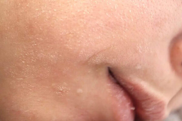 Understanding thyroid disorders: How hypothyroidism and hyperthyroidism impact skin, hair, and nail health |