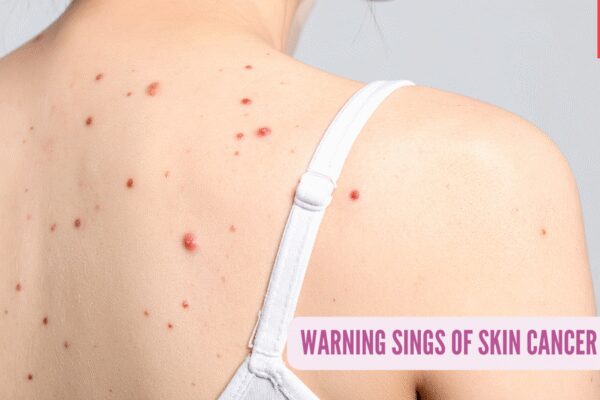 Board-certified cardiologist and dermat reveals 10 signs of skin cancer