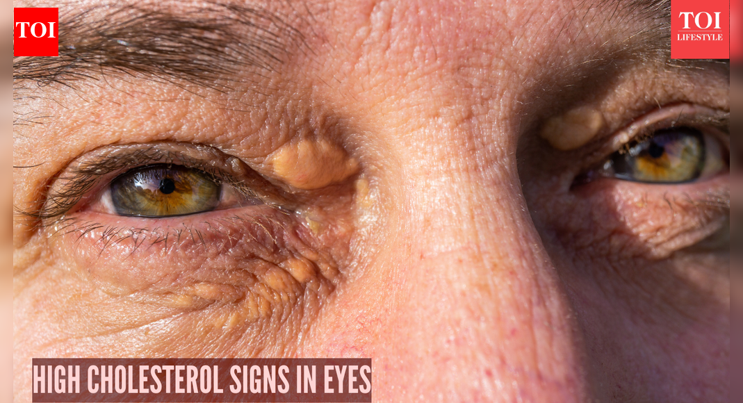 High Cholesterol Symptoms: High cholesterol in the eyes: 5 warning signs you need to look out for |