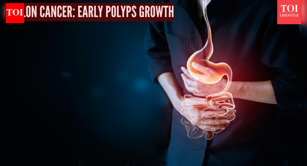 Colon cancer: Doctor explains how early polyps grow quietly and how screening saves lives