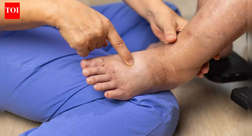 What causes swollen feet and ankles: The hidden reasons behind pedal oedema from heart, liver, kidney disease and DVT |