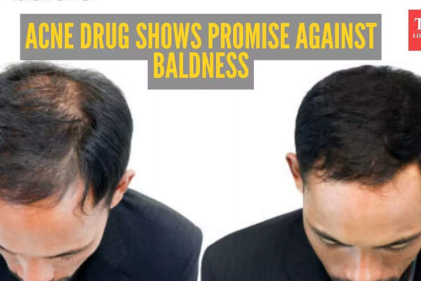 Breakthrough in finding cure for baldness: Common acne drug shows remarkable results in treating Male Pattern Baldness |