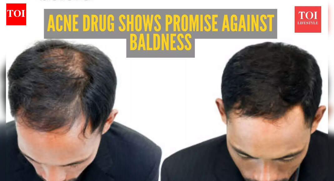 Breakthrough in finding cure for baldness: Common acne drug shows remarkable results in treating Male Pattern Baldness |
