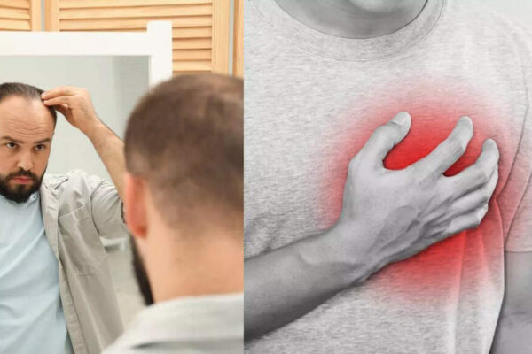 Severe hair loss in men may signal early heart problems: What new research reveals |