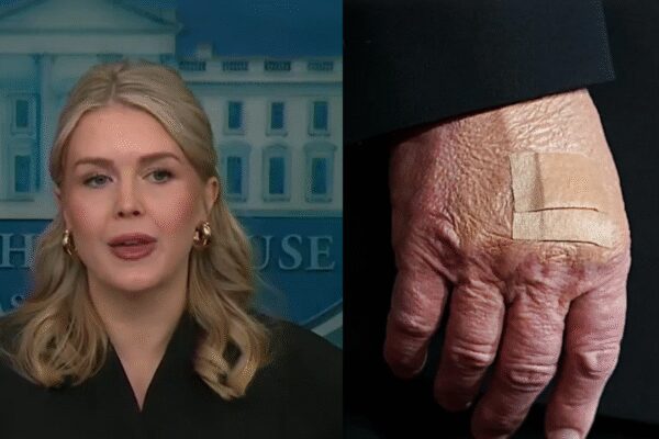 Karoline Leavitt reveals why there are bandages on Trump’s hand: ‘The president is literally…’