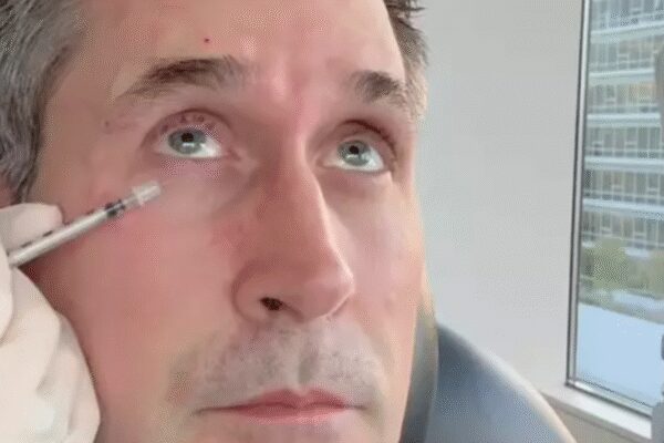 Botox on just one side: Doctor injects half of husband’s face to show ‘shocking’ before-and-after |