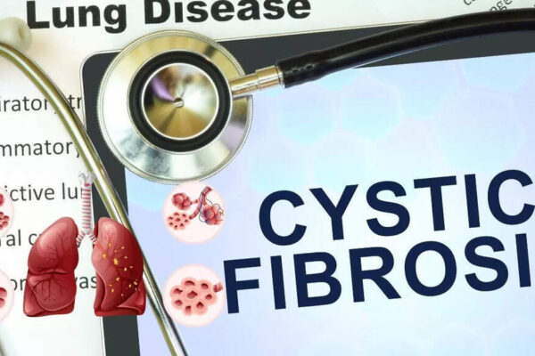 Cystic Fibrosis: Causes, symptoms, diagnosis and modern treatment approaches |